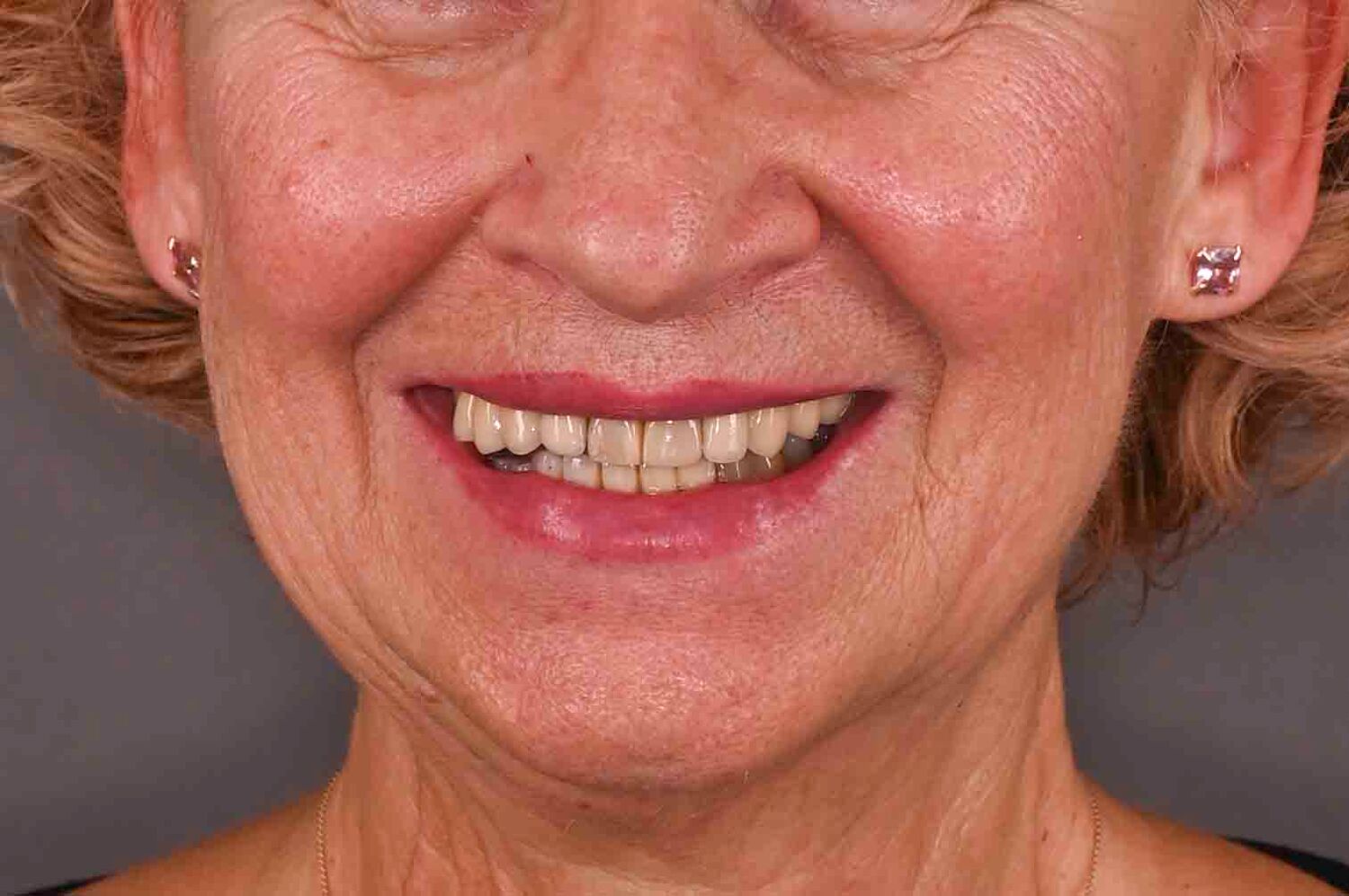 Pacient Clinica Dr. Alin Odor - Rezultat Implantologie